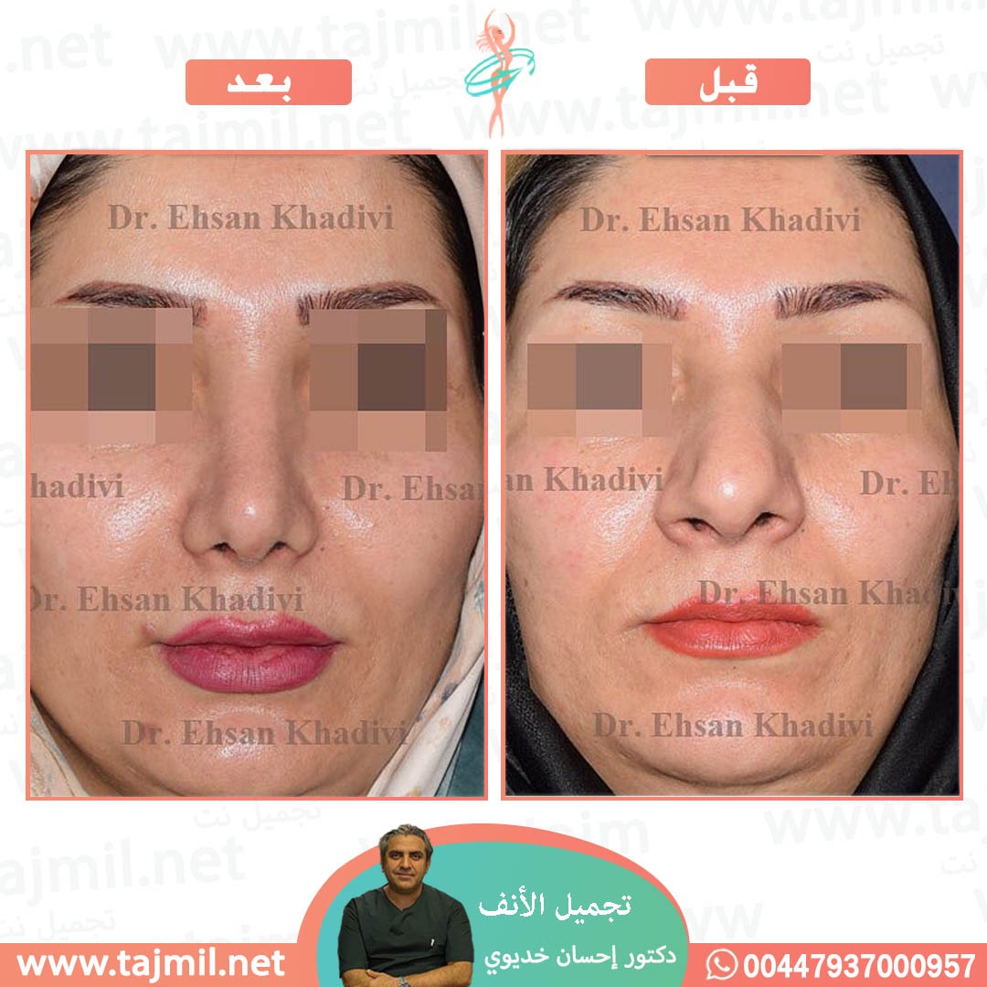  - دکتور إحسان خدیوي عملية تجميل الانف في ايران مع تجميل نت