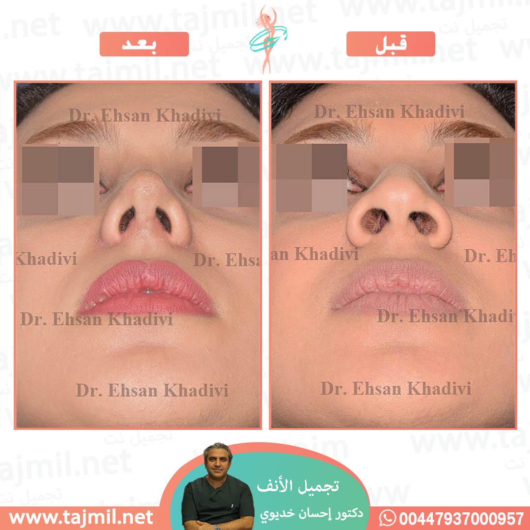  - دکتور إحسان خدیوي عملية تجميل الانف في ايران مع تجميل نت