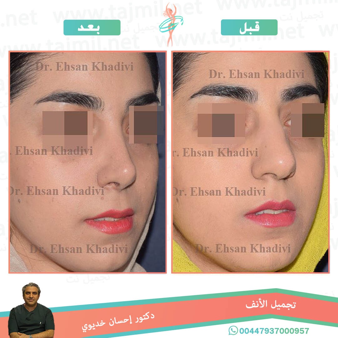  - دکتور إحسان خدیوي عملية تجميل الانف في ايران مع تجميل نت