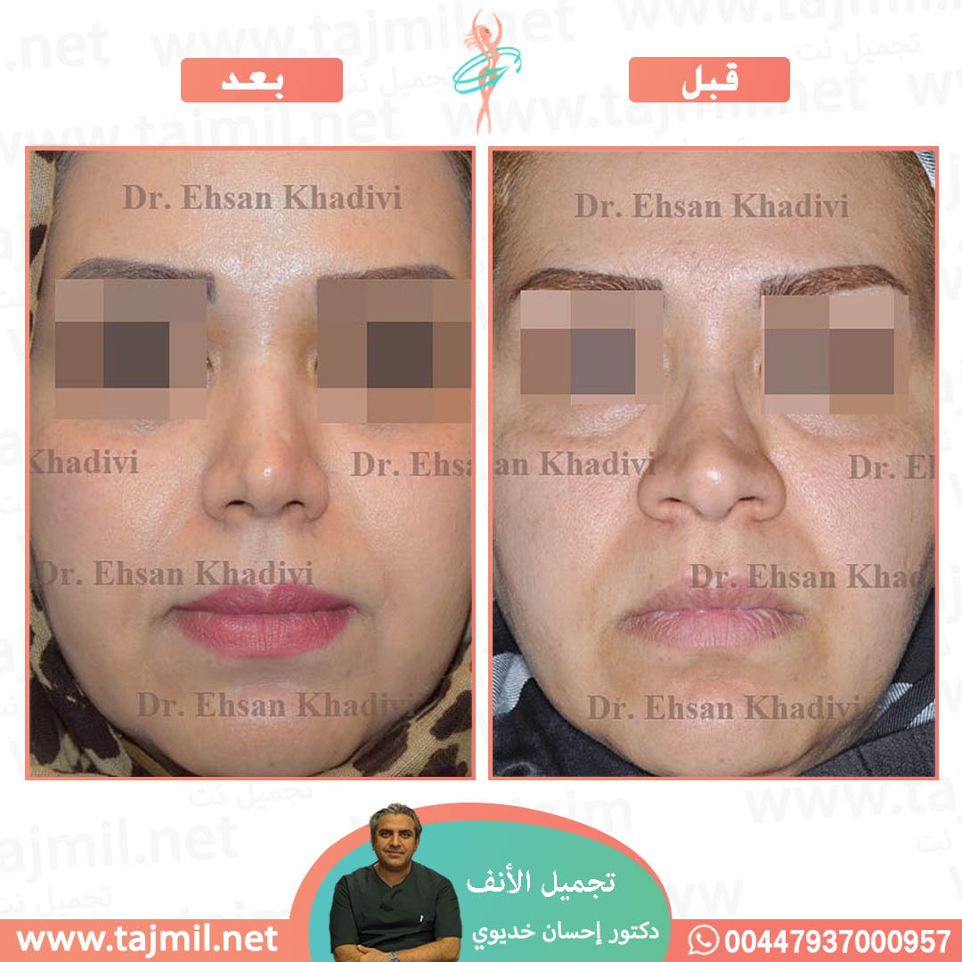  - دکتور إحسان خدیوي عملية تجميل الانف في ايران مع تجميل نت