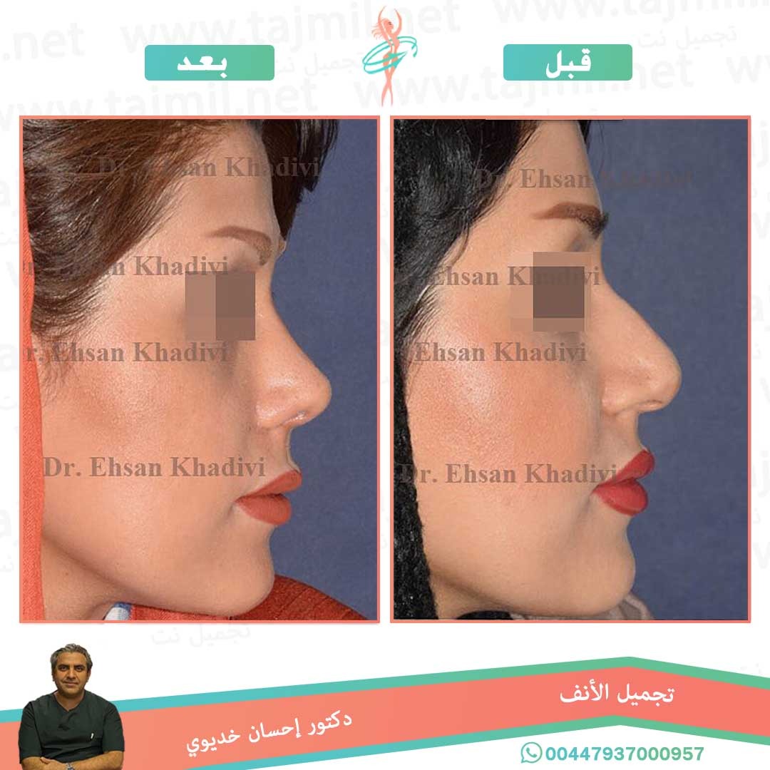  - دکتور إحسان خدیوي عملية تجميل الانف في ايران مع تجميل نت