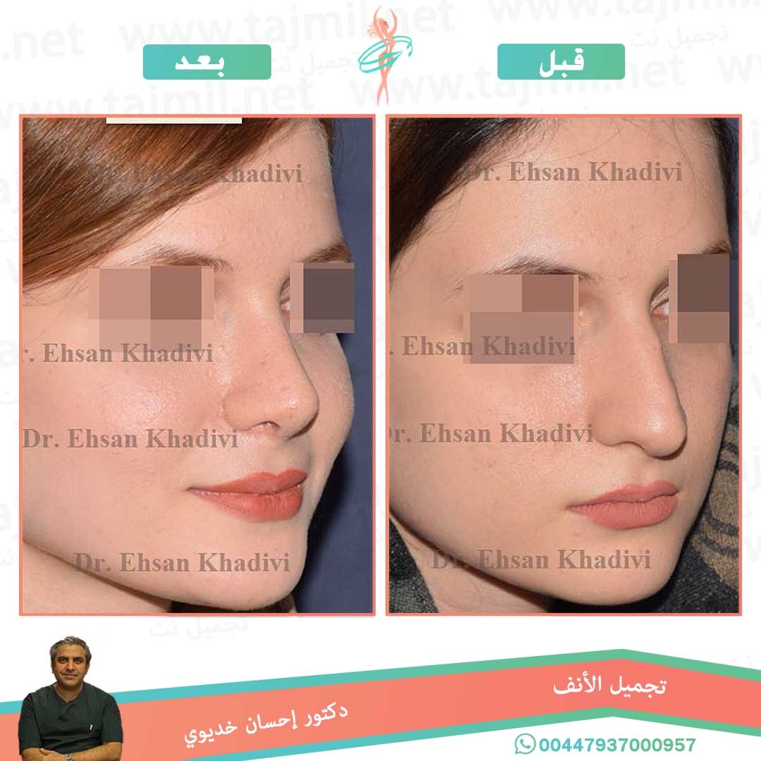  - دکتور إحسان خدیوي عملية تجميل الانف في ايران مع تجميل نت