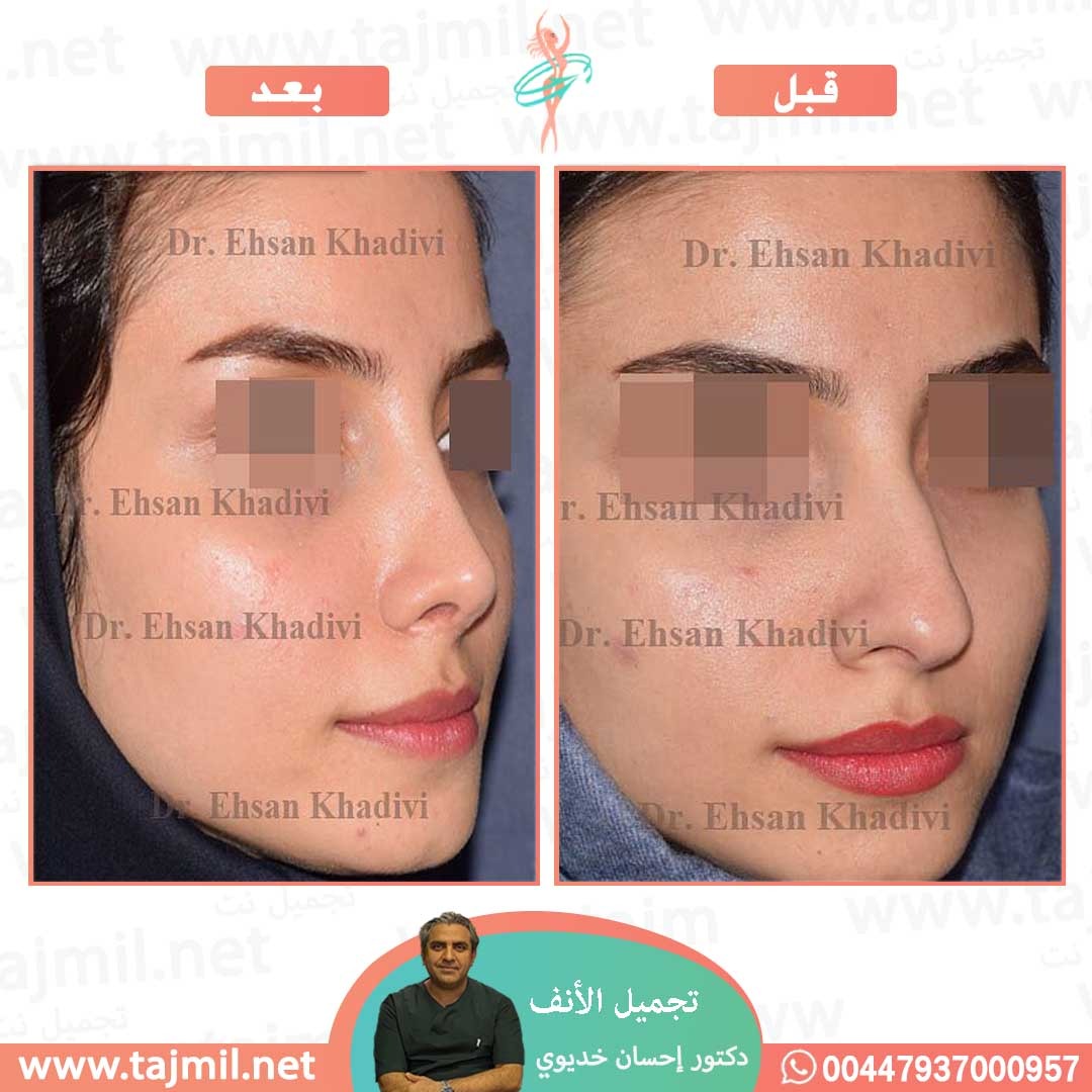  - دکتور إحسان خدیوي عملية تجميل الانف في ايران مع تجميل نت