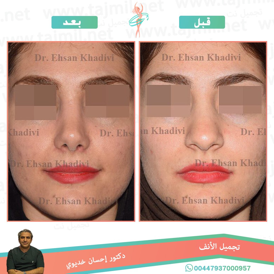  - دکتور إحسان خدیوي عملية تجميل الانف في ايران مع تجميل نت