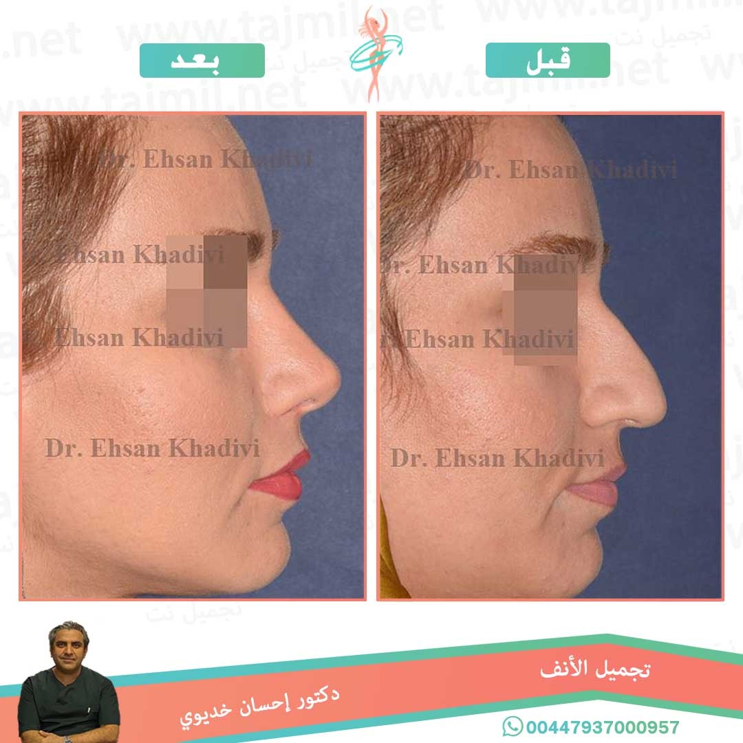  - دکتور إحسان خدیوي عملية تجميل الانف في ايران مع تجميل نت