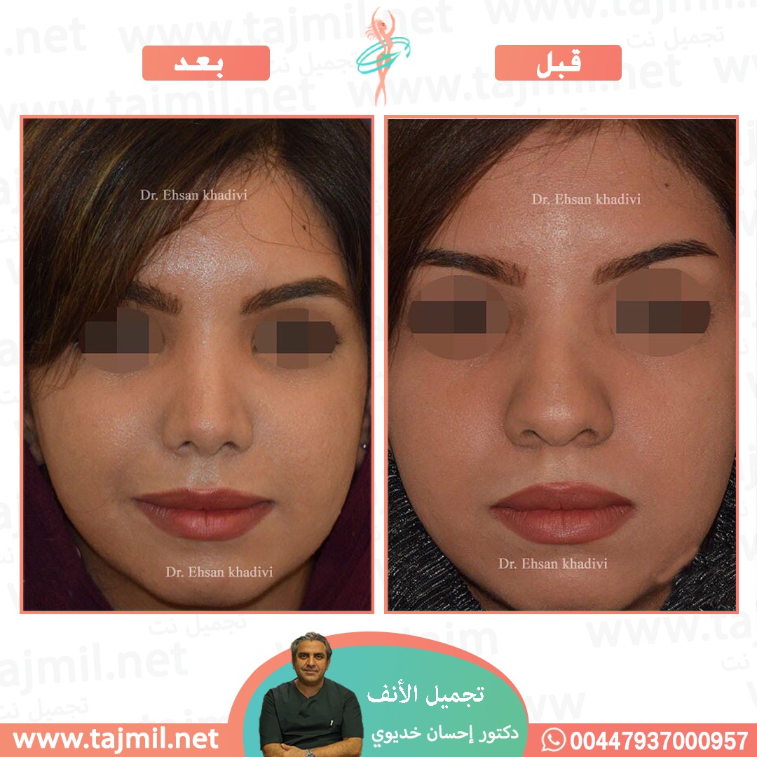  - دکتور إحسان خدیوي عملية تجميل الانف في ايران مع تجميل نت