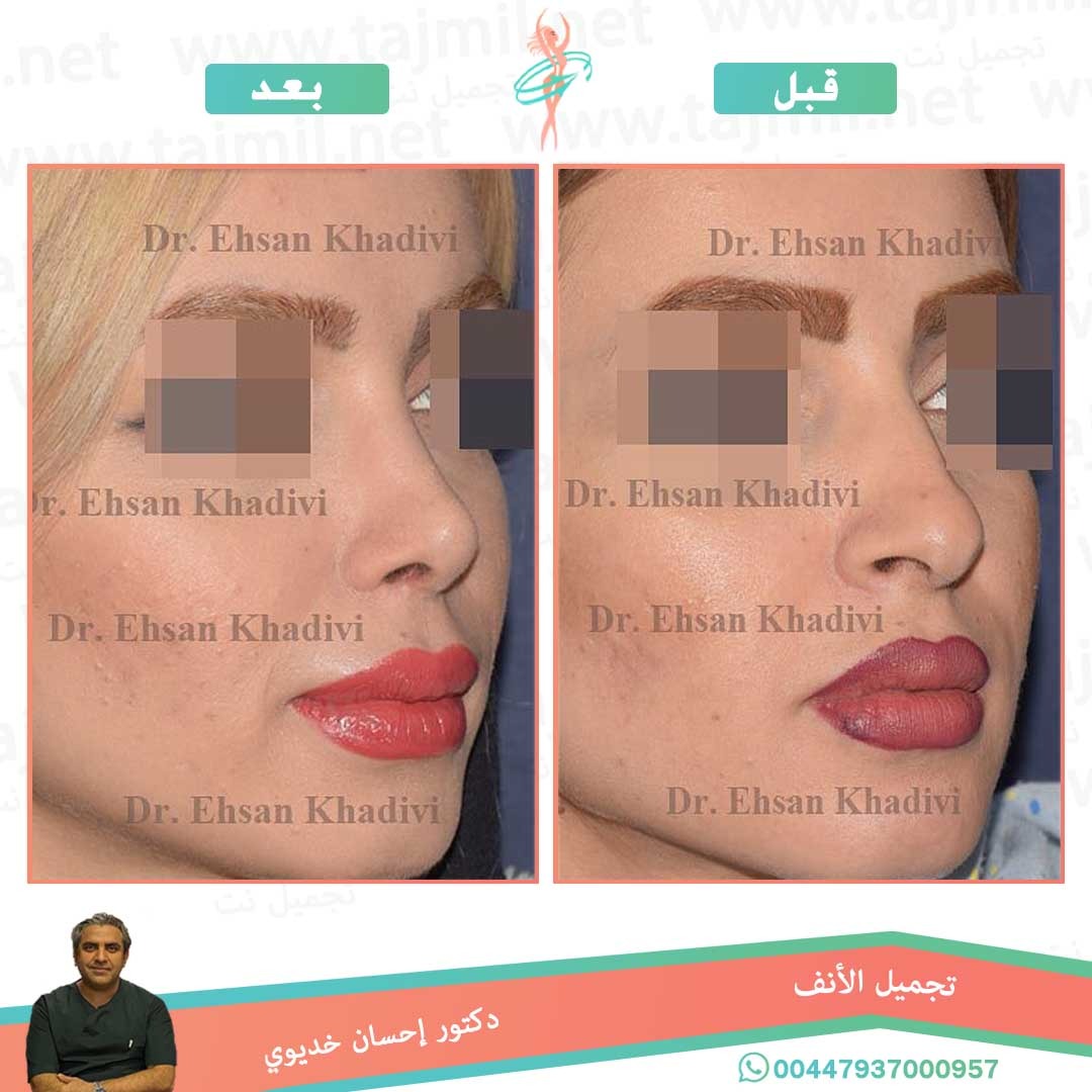  - دکتور إحسان خدیوي عملية تجميل الانف في ايران مع تجميل نت