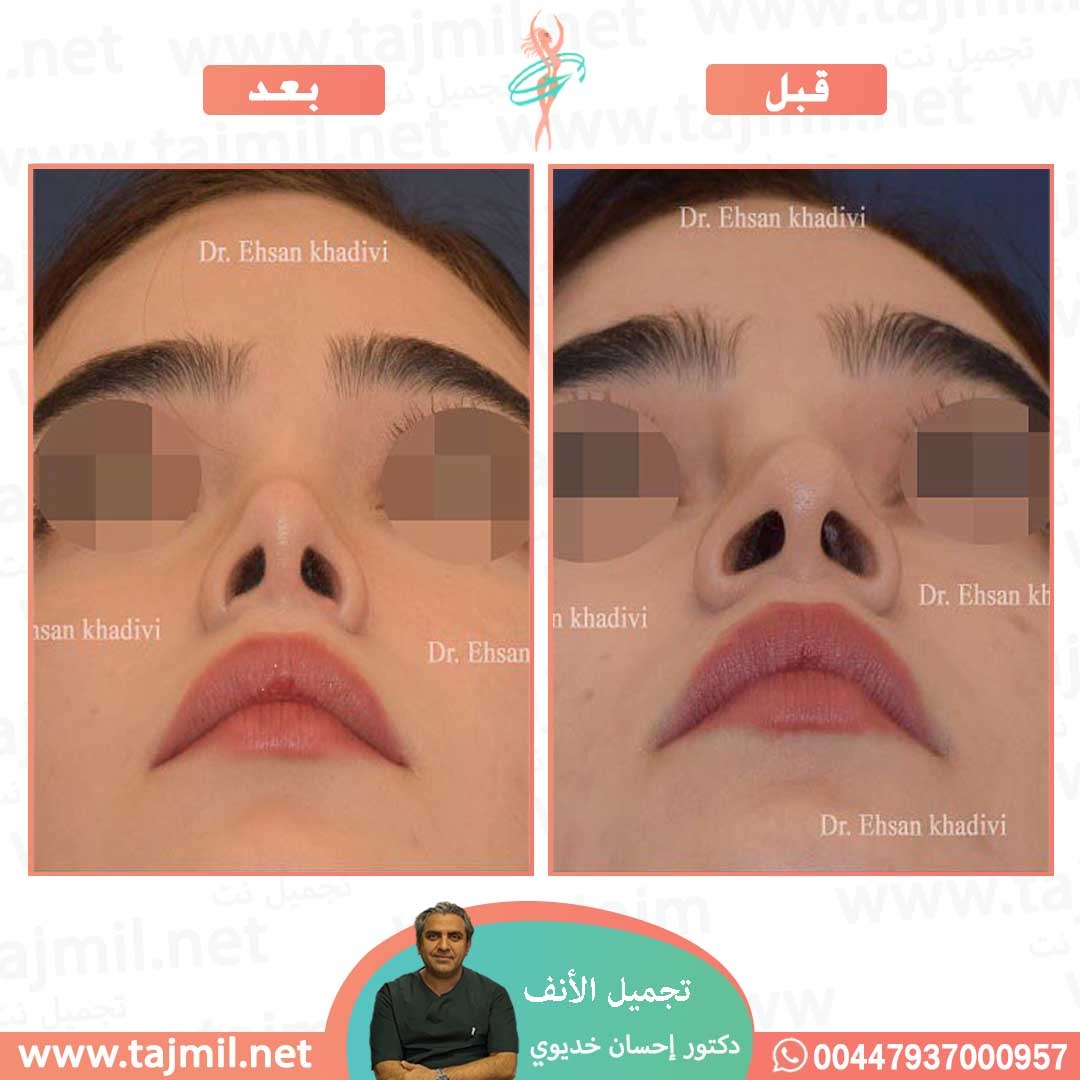  - دکتور إحسان خدیوي عملية تجميل الانف في ايران مع تجميل نت