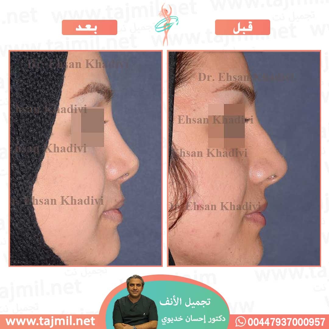  - دکتور إحسان خدیوي عملية تجميل الانف في ايران مع تجميل نت