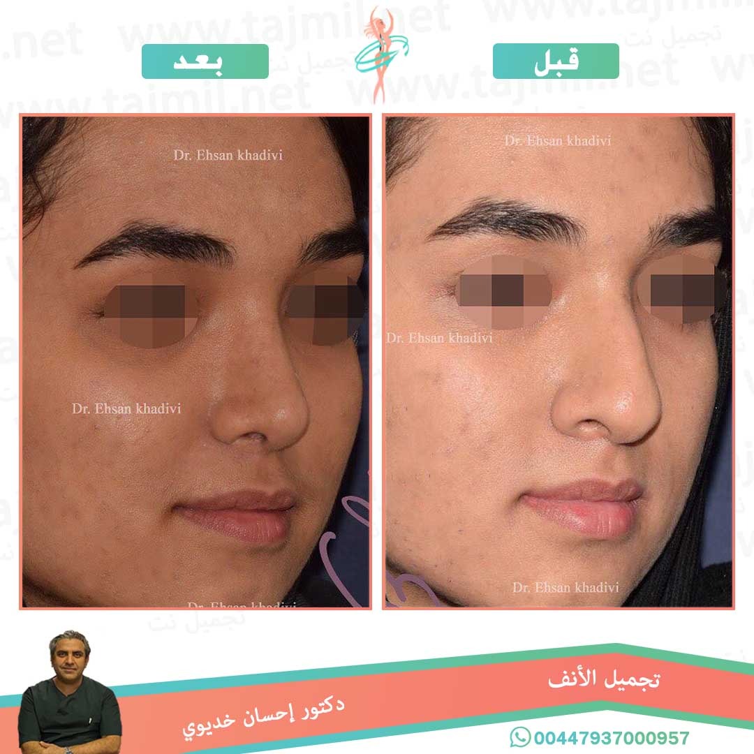  - دکتور إحسان خدیوي عملية تجميل الانف في ايران مع تجميل نت