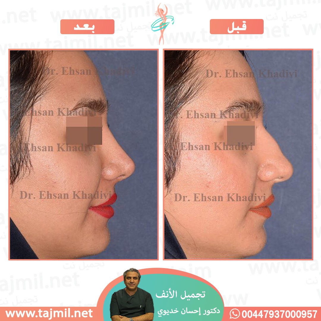  - دکتور إحسان خدیوي عملية تجميل الانف في ايران مع تجميل نت