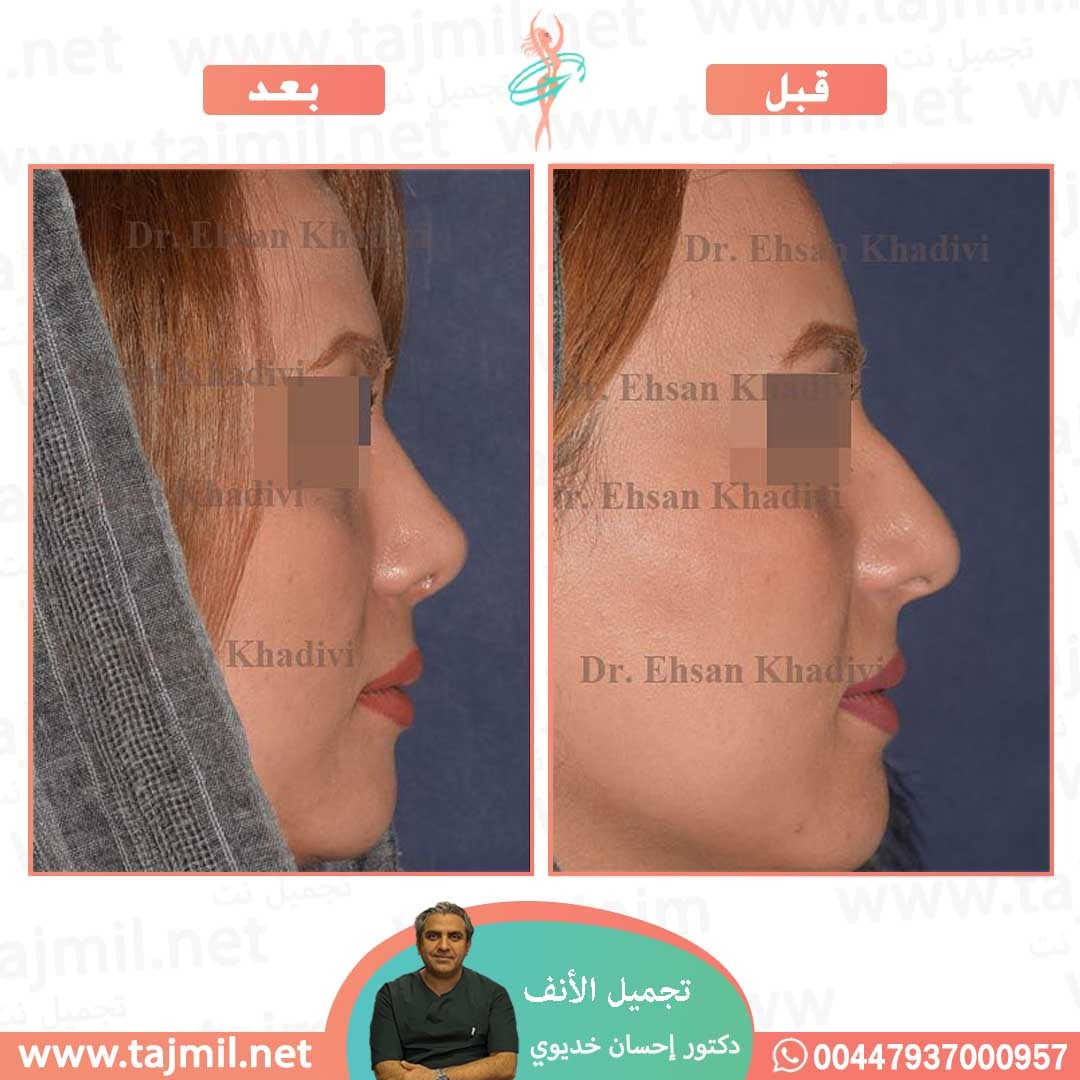  - دکتور إحسان خدیوي عملية تجميل الانف في ايران مع تجميل نت