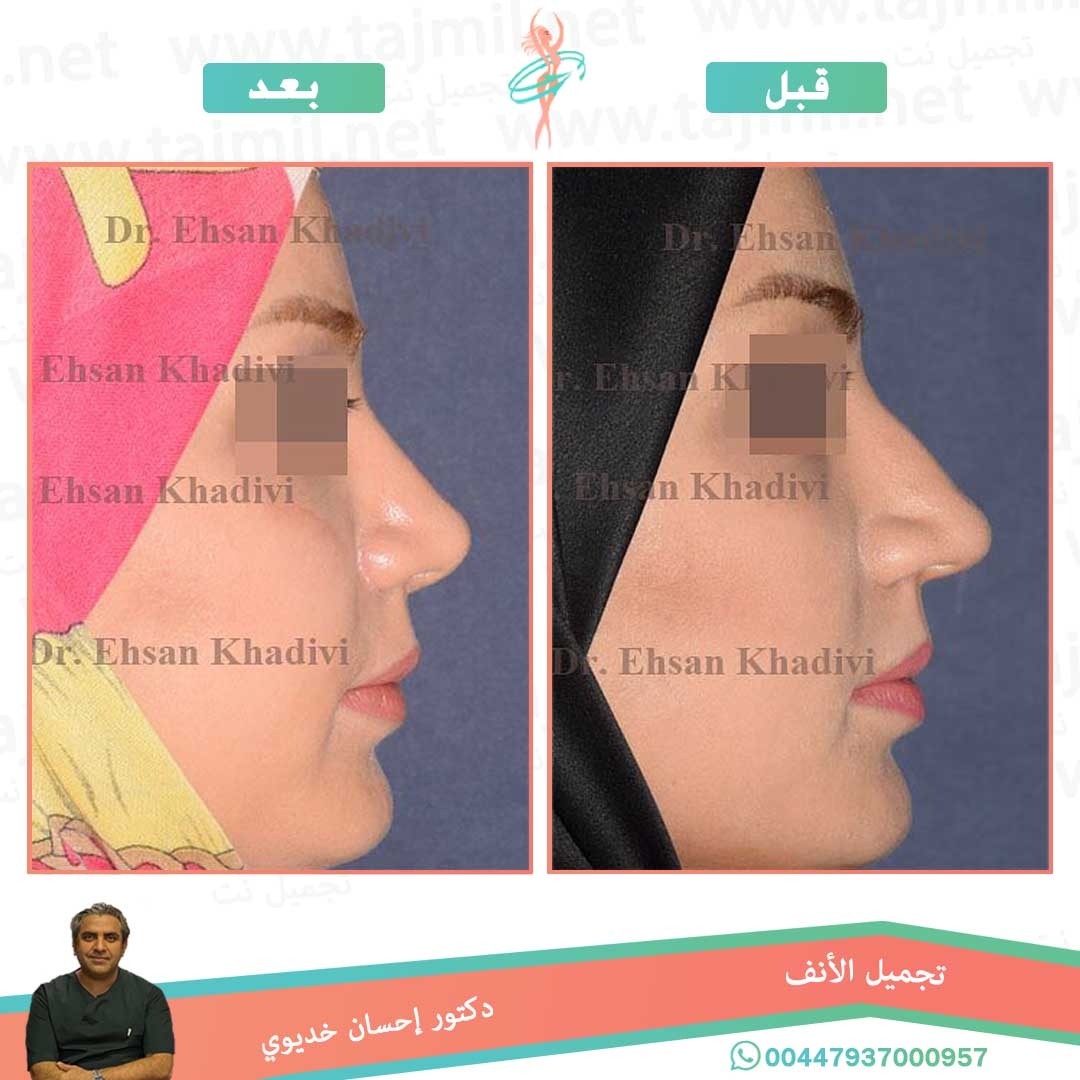  - دکتور إحسان خدیوي عملية تجميل الانف في ايران مع تجميل نت