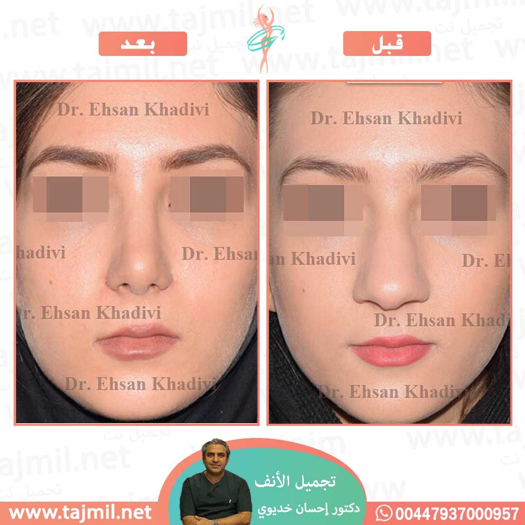  - دکتور إحسان خدیوي عملية تجميل الانف في ايران مع تجميل نت