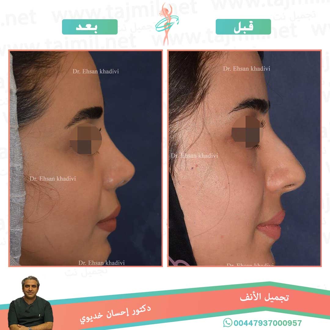  - دکتور إحسان خدیوي عملية تجميل الانف في ايران مع تجميل نت