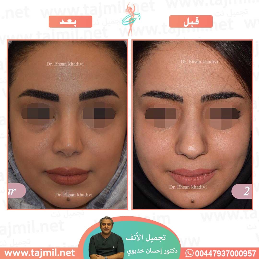  - دکتور إحسان خدیوي عملية تجميل الانف في ايران مع تجميل نت