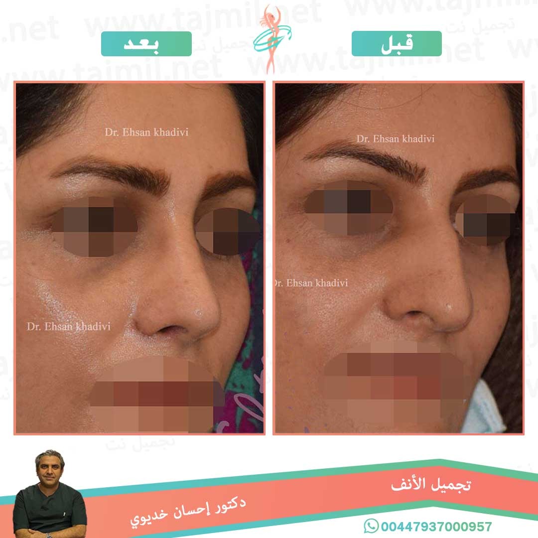  - دکتور إحسان خدیوي عملية تجميل الانف في ايران مع تجميل نت