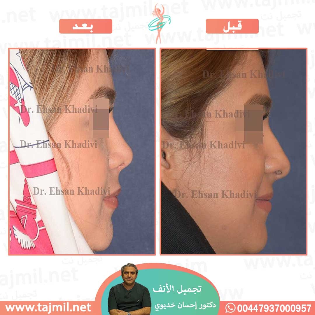  - دکتور إحسان خدیوي عملية تجميل الانف في ايران مع تجميل نت