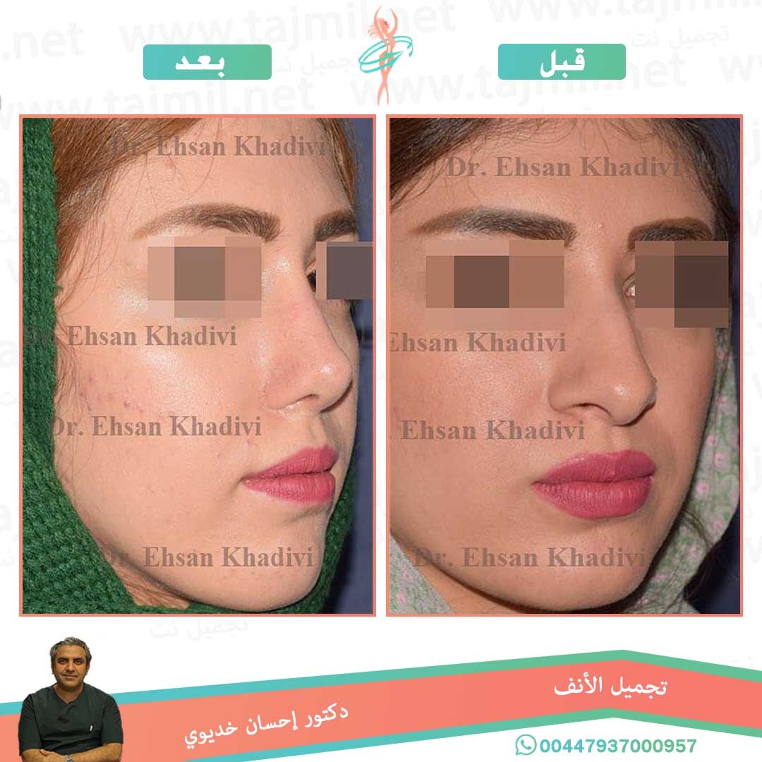  - دکتور إحسان خدیوي عملية تجميل الانف في ايران مع تجميل نت