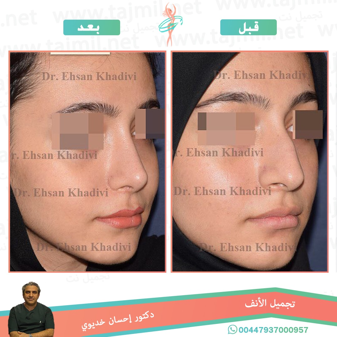  - دکتور إحسان خدیوي عملية تجميل الانف في ايران مع تجميل نت