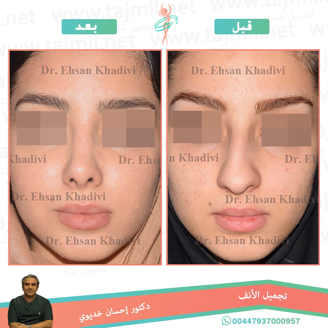  - دکتور إحسان خدیوي عملية تجميل الانف في ايران مع تجميل نت