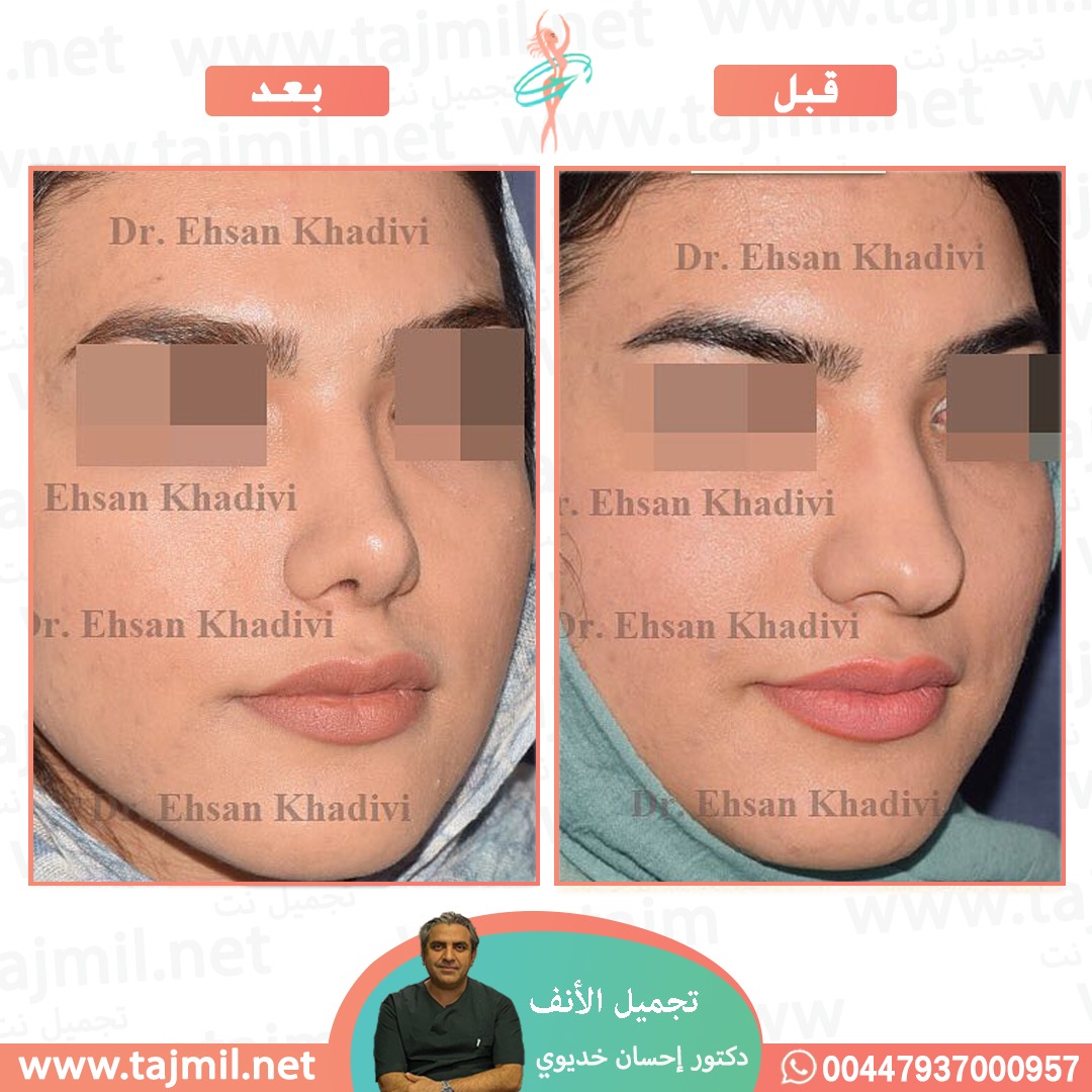  - دکتور إحسان خدیوي عملية تجميل الانف في ايران مع تجميل نت