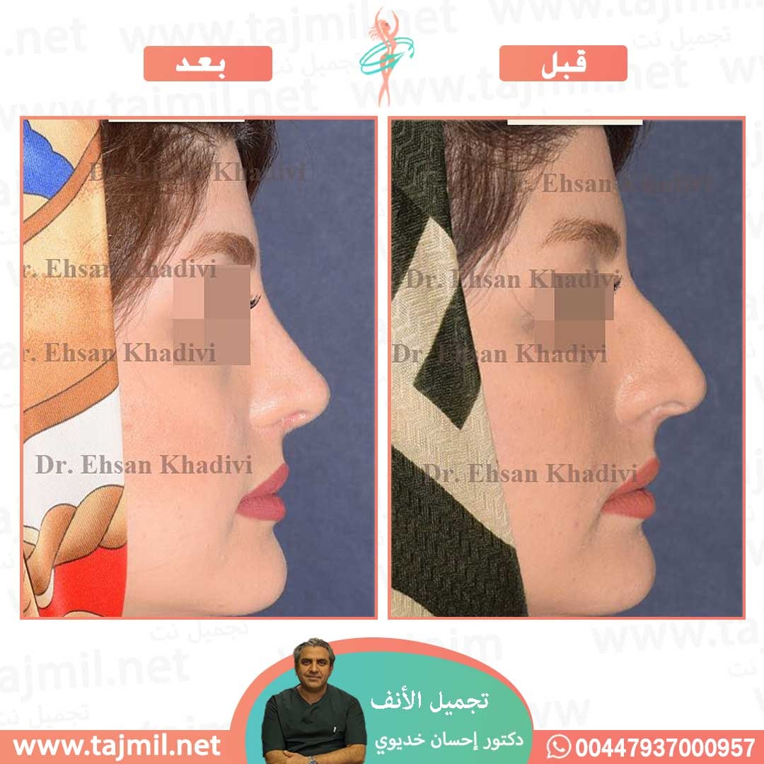  - دکتور إحسان خدیوي عملية تجميل الانف في ايران مع تجميل نت