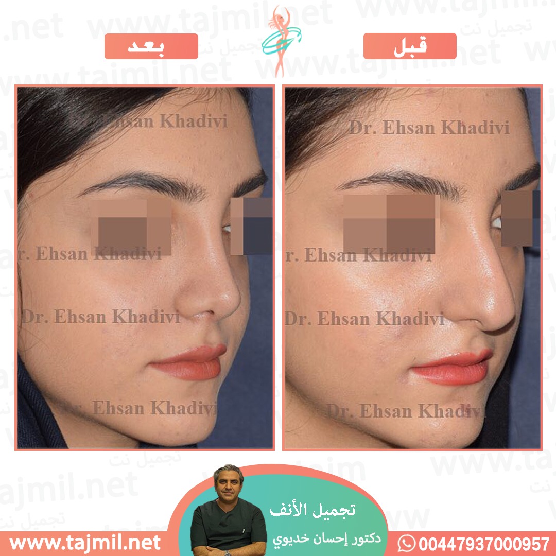  - دکتور إحسان خدیوي عملية تجميل الانف في ايران مع تجميل نت