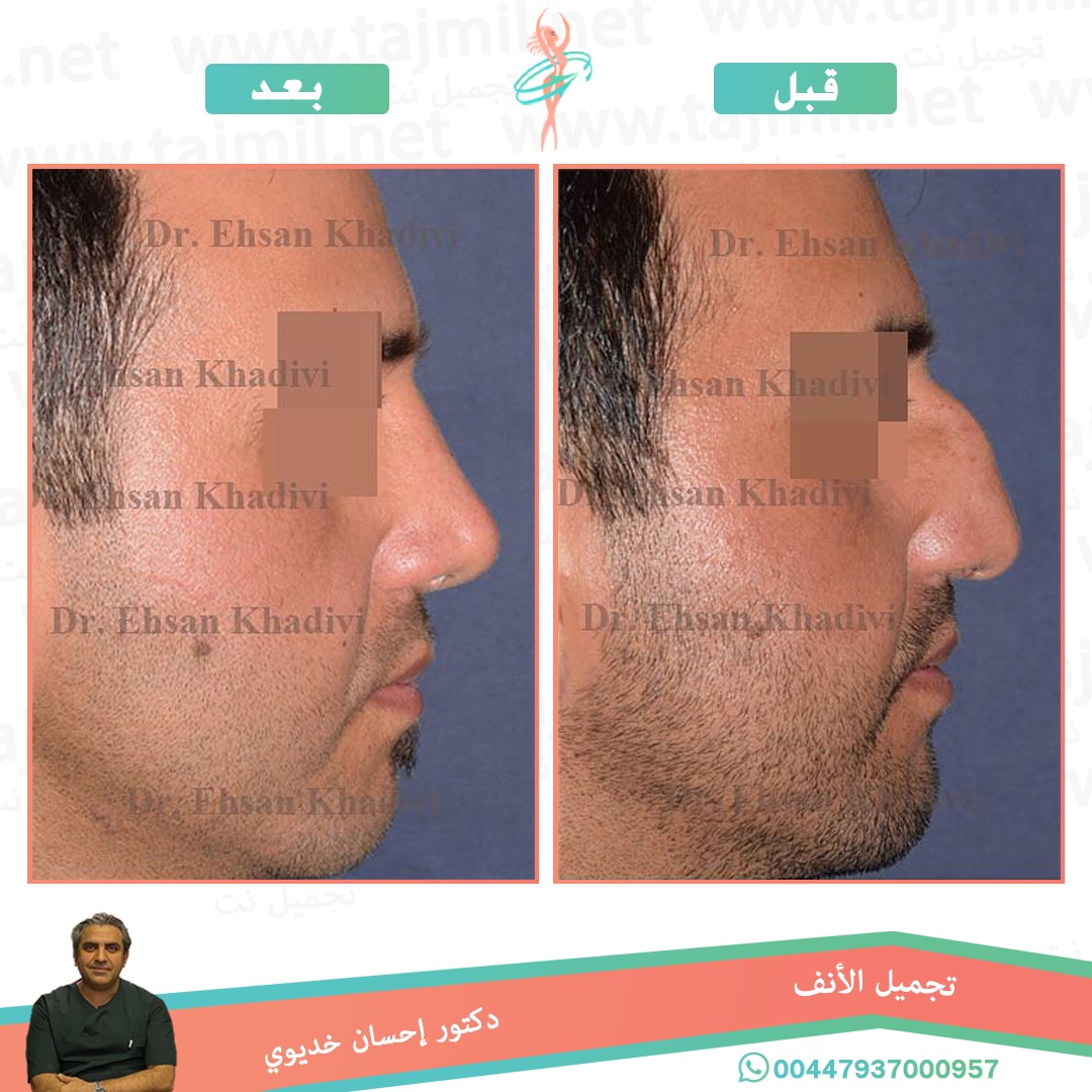  - دکتور إحسان خدیوي عملية تجميل الانف في ايران مع تجميل نت