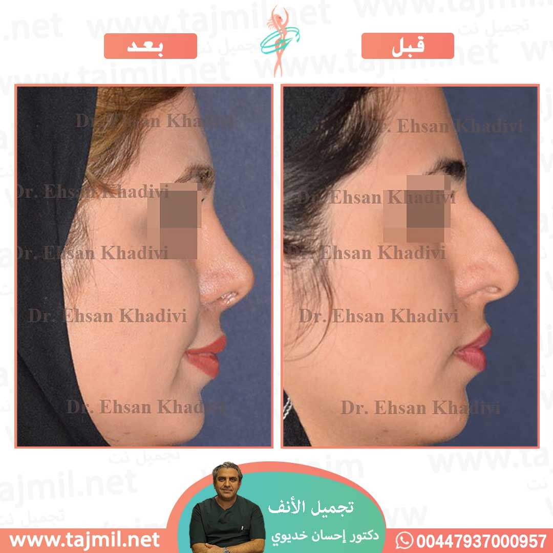  - دکتور إحسان خدیوي عملية تجميل الانف في ايران مع تجميل نت