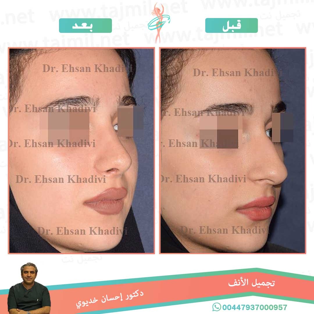  - دکتور إحسان خدیوي عملية تجميل الانف في ايران مع تجميل نت