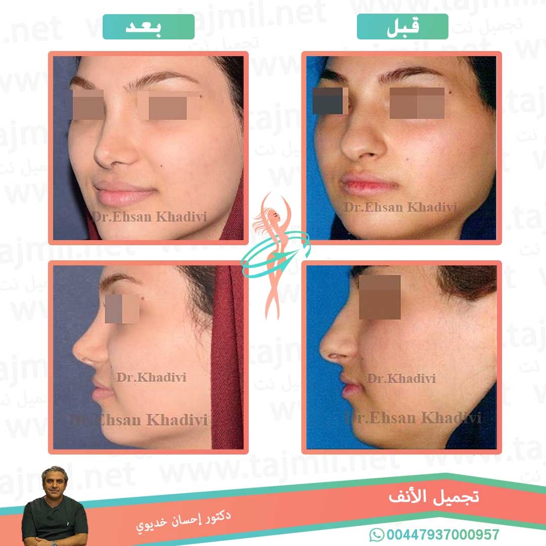  - دکتور إحسان خدیوي عملية تجميل الانف في ايران مع تجميل نت