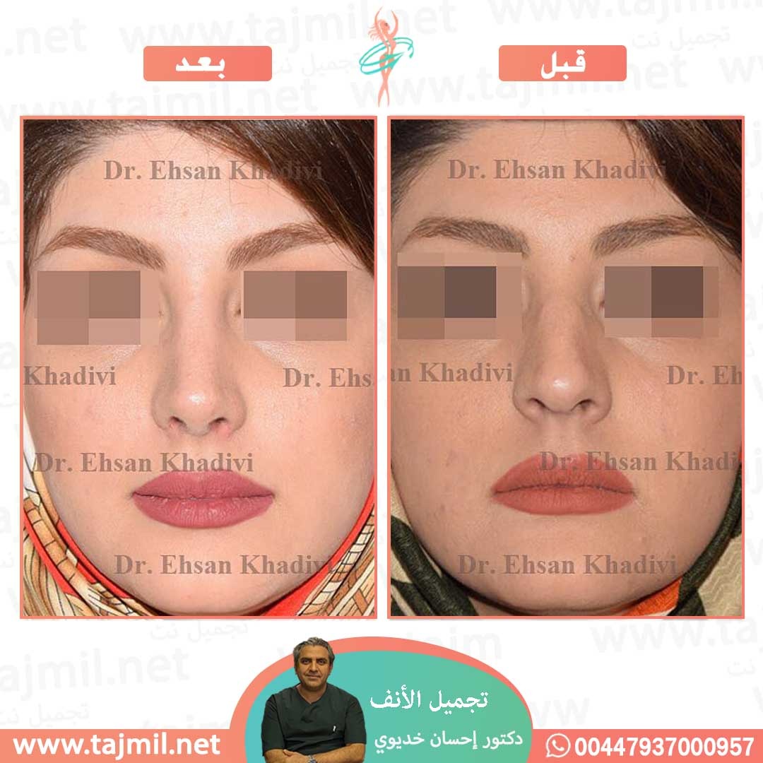  - دکتور إحسان خدیوي عملية تجميل الانف في ايران مع تجميل نت