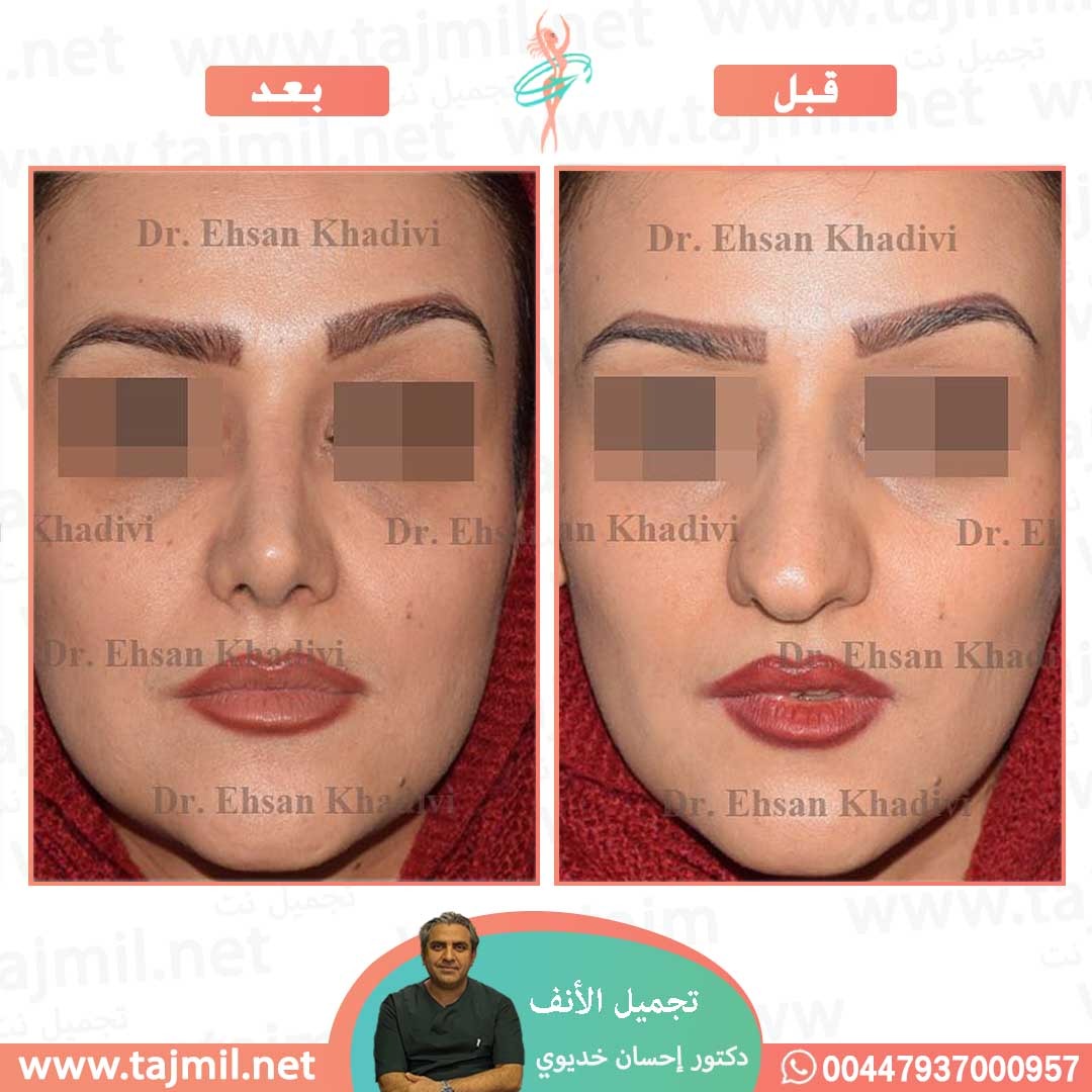  - دکتور إحسان خدیوي عملية تجميل الانف في ايران مع تجميل نت