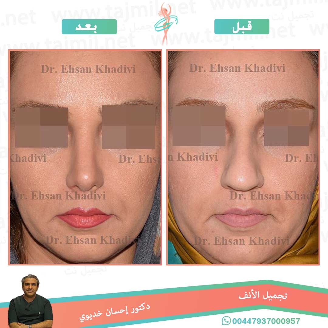  - دکتور إحسان خدیوي عملية تجميل الانف في ايران مع تجميل نت