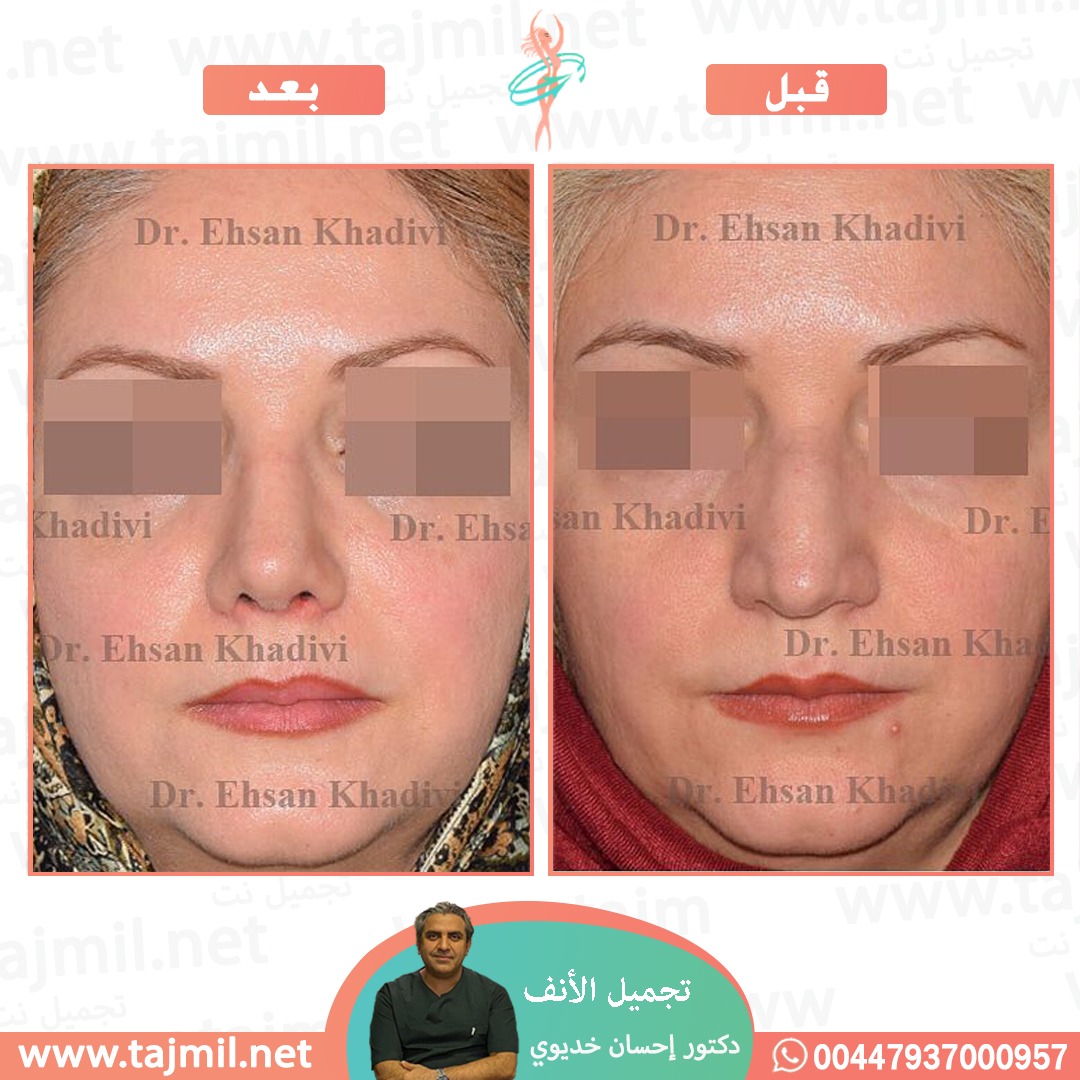  - دکتور إحسان خدیوي عملية تجميل الانف في ايران مع تجميل نت