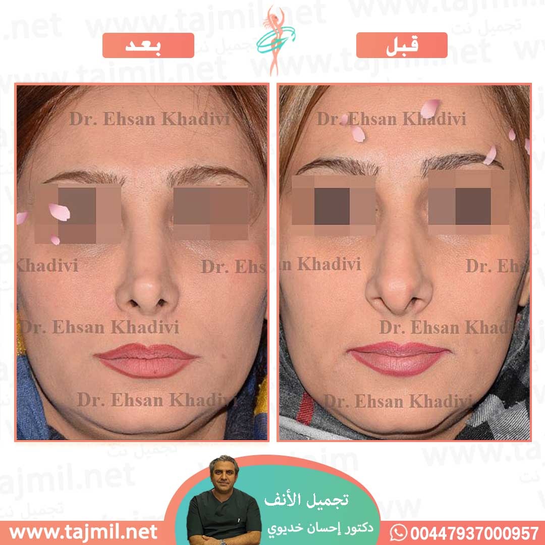  - دکتور إحسان خدیوي عملية تجميل الانف في ايران مع تجميل نت