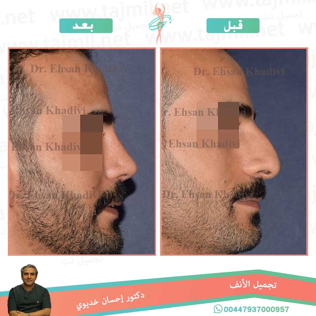  - دکتور إحسان خدیوي عملية تجميل الانف في ايران مع تجميل نت