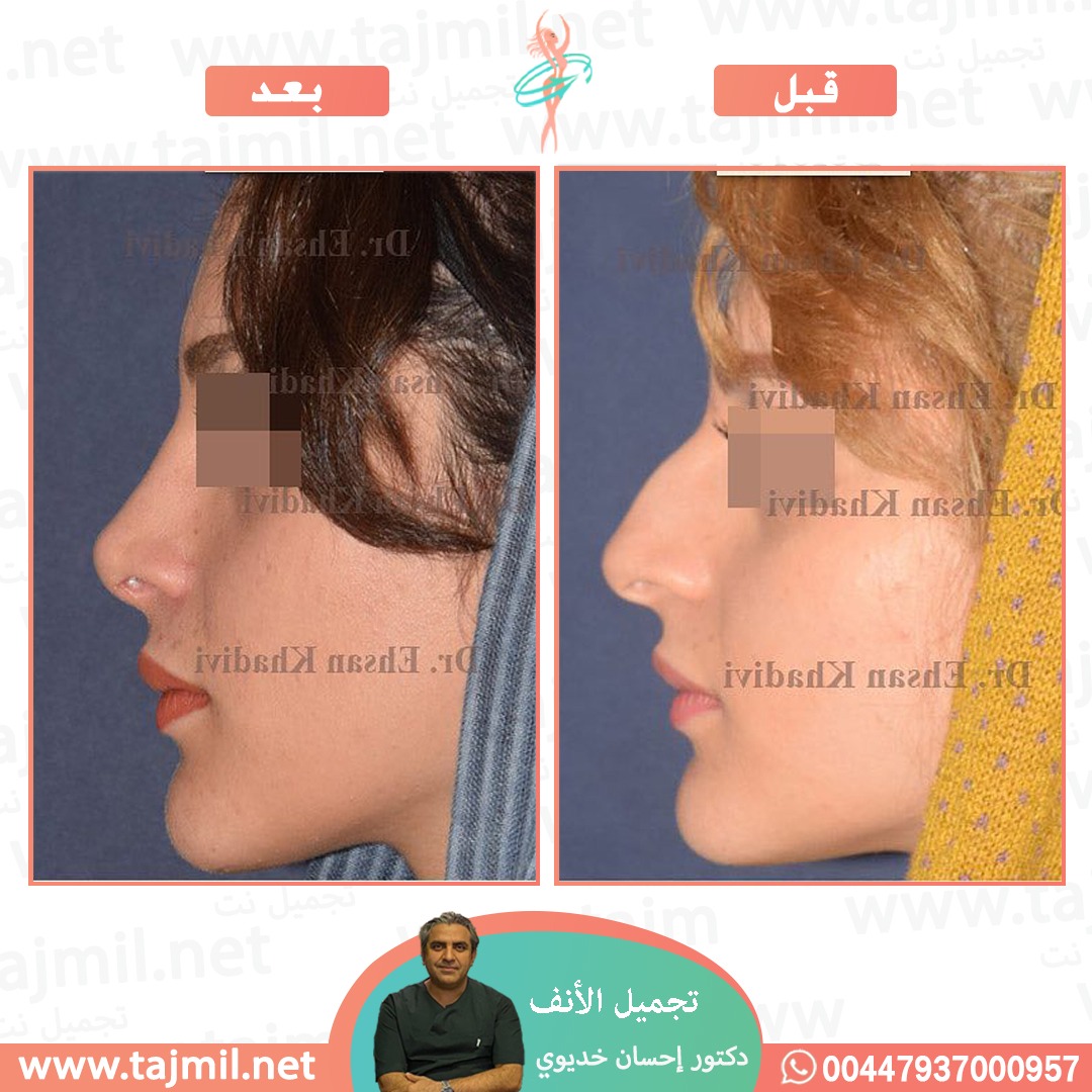  - دکتور إحسان خدیوي عملية تجميل الانف في ايران مع تجميل نت