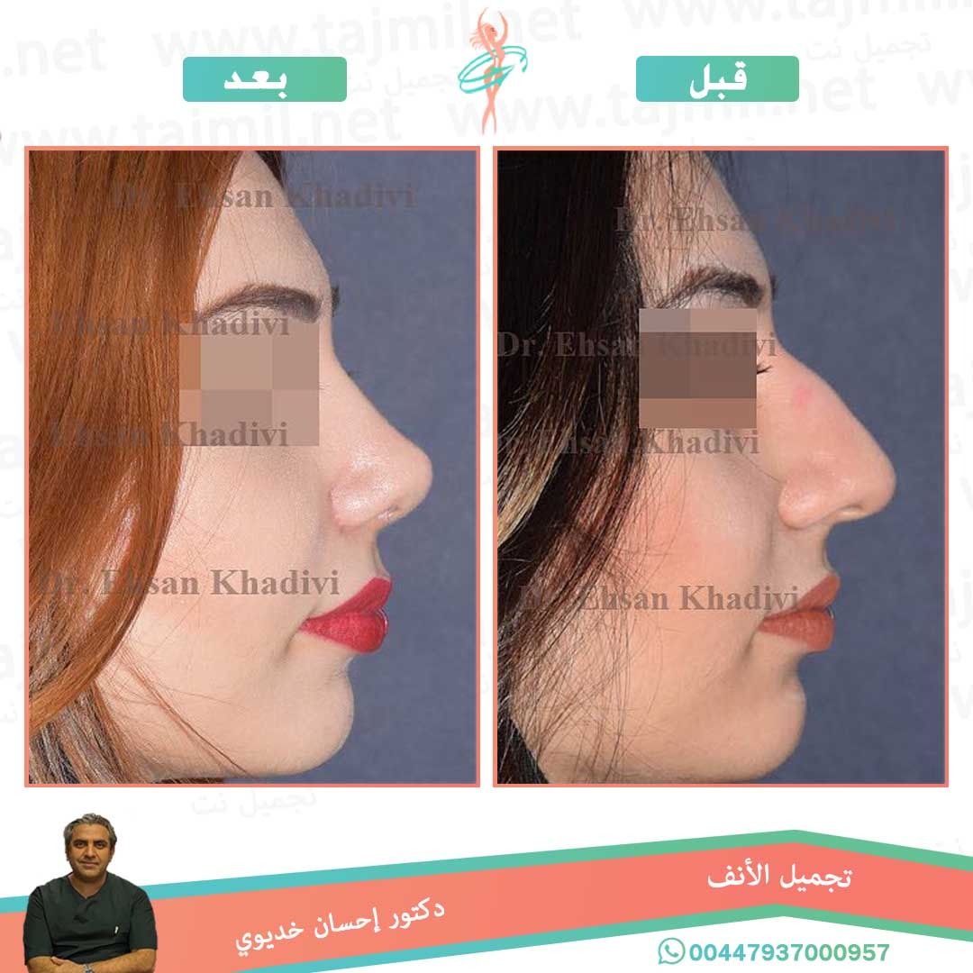  - دکتور إحسان خدیوي عملية تجميل الانف في ايران مع تجميل نت