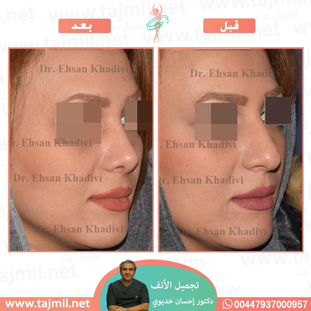  - دکتور إحسان خدیوي عملية تجميل الانف في ايران مع تجميل نت