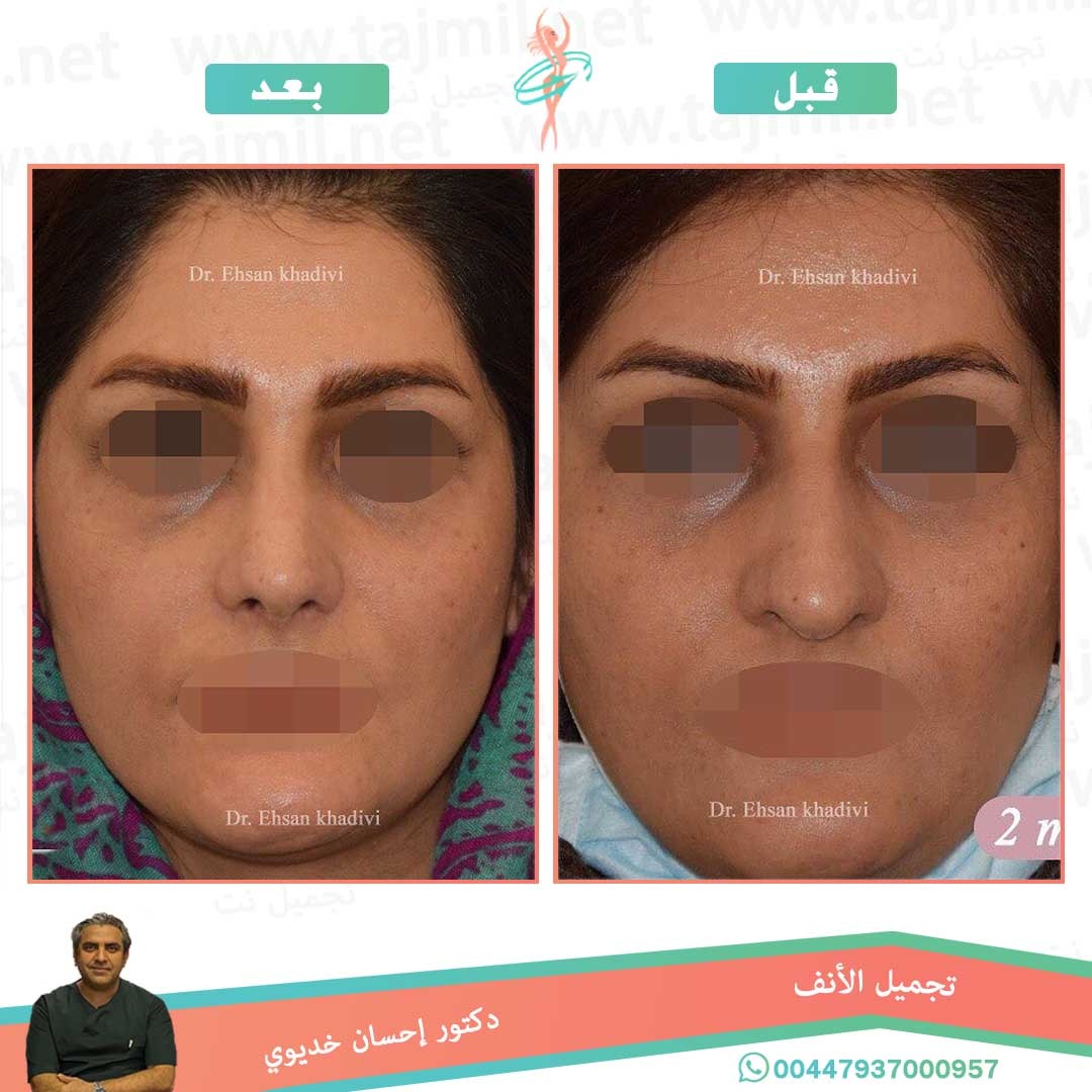  - دکتور إحسان خدیوي عملية تجميل الانف في ايران مع تجميل نت