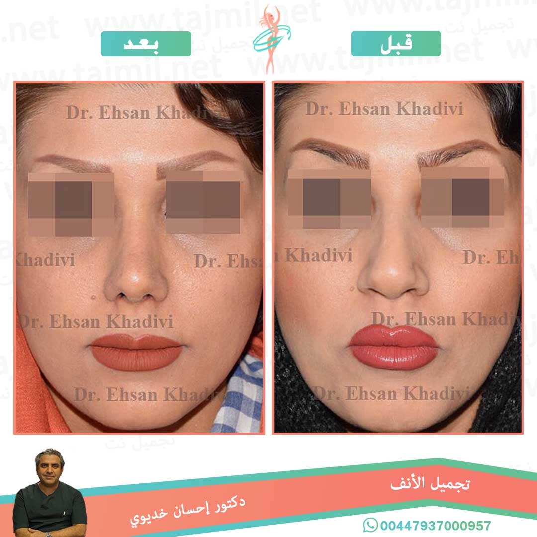  - دکتور إحسان خدیوي عملية تجميل الانف في ايران مع تجميل نت