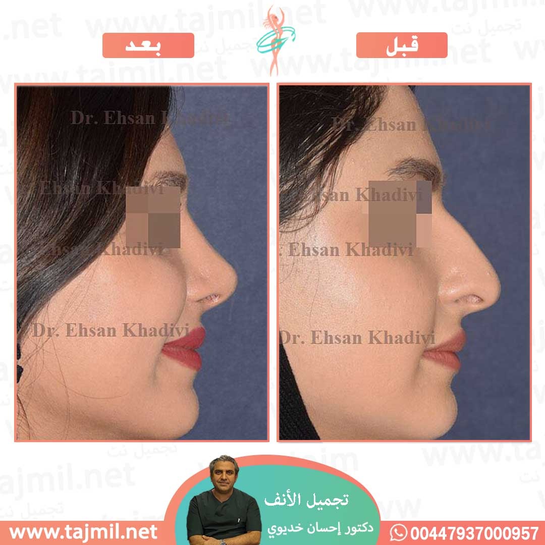  - دکتور إحسان خدیوي عملية تجميل الانف في ايران مع تجميل نت