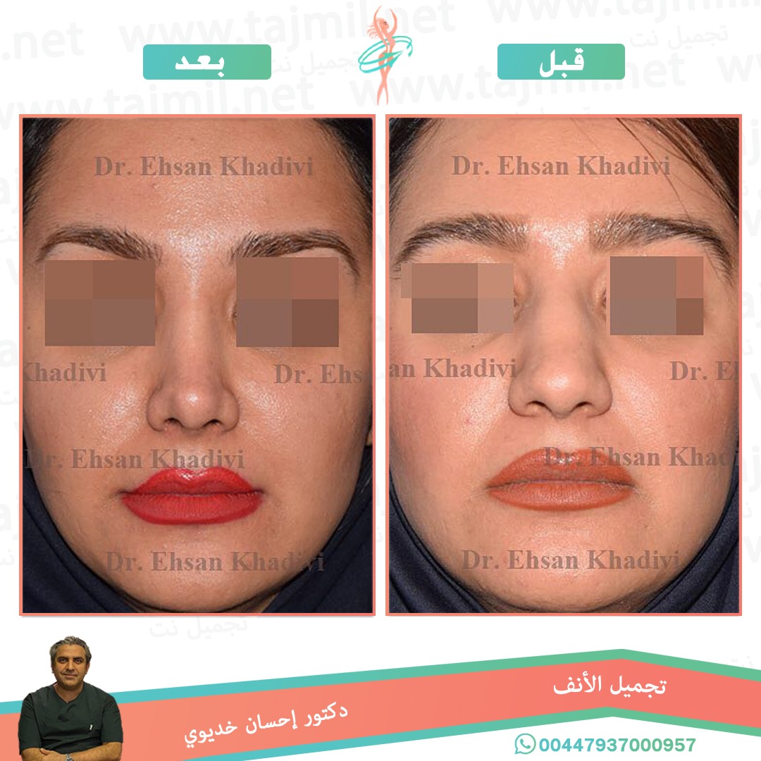  - دکتور إحسان خدیوي عملية تجميل الانف في ايران مع تجميل نت