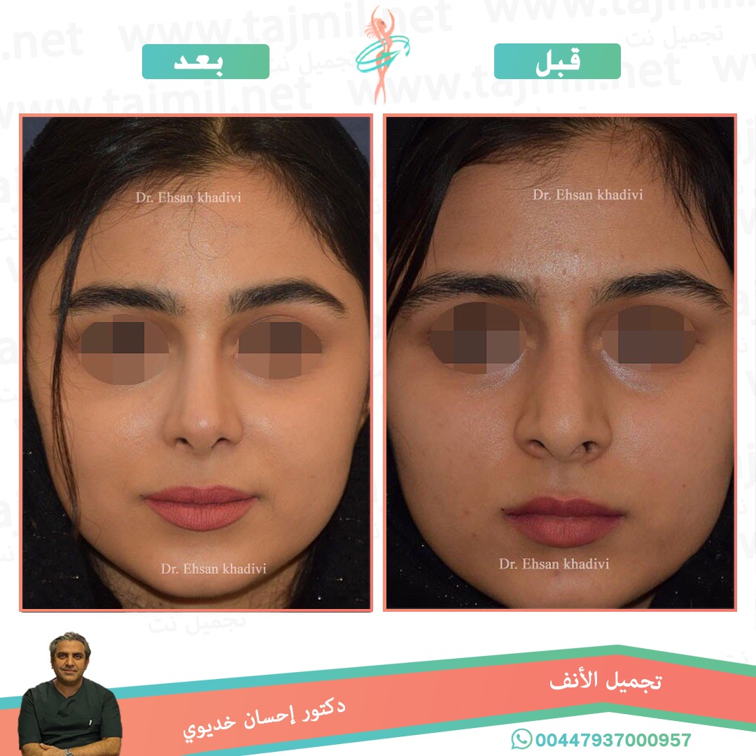  - دکتور إحسان خدیوي عملية تجميل الانف في ايران مع تجميل نت