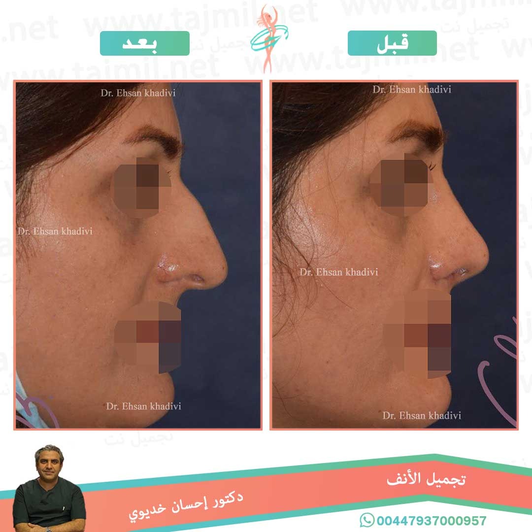  - دکتور إحسان خدیوي عملية تجميل الانف في ايران مع تجميل نت