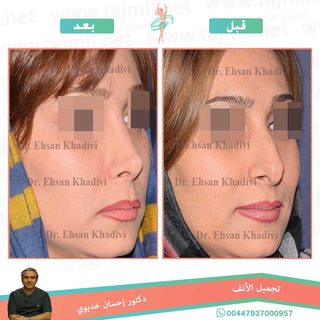  - دکتور إحسان خدیوي عملية تجميل الانف في ايران مع تجميل نت