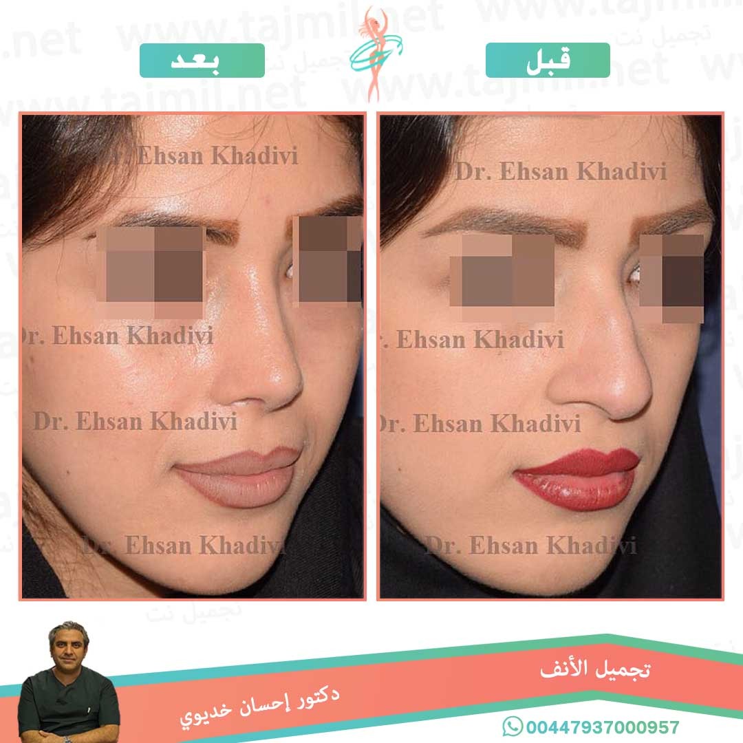  - دکتور إحسان خدیوي عملية تجميل الانف في ايران مع تجميل نت