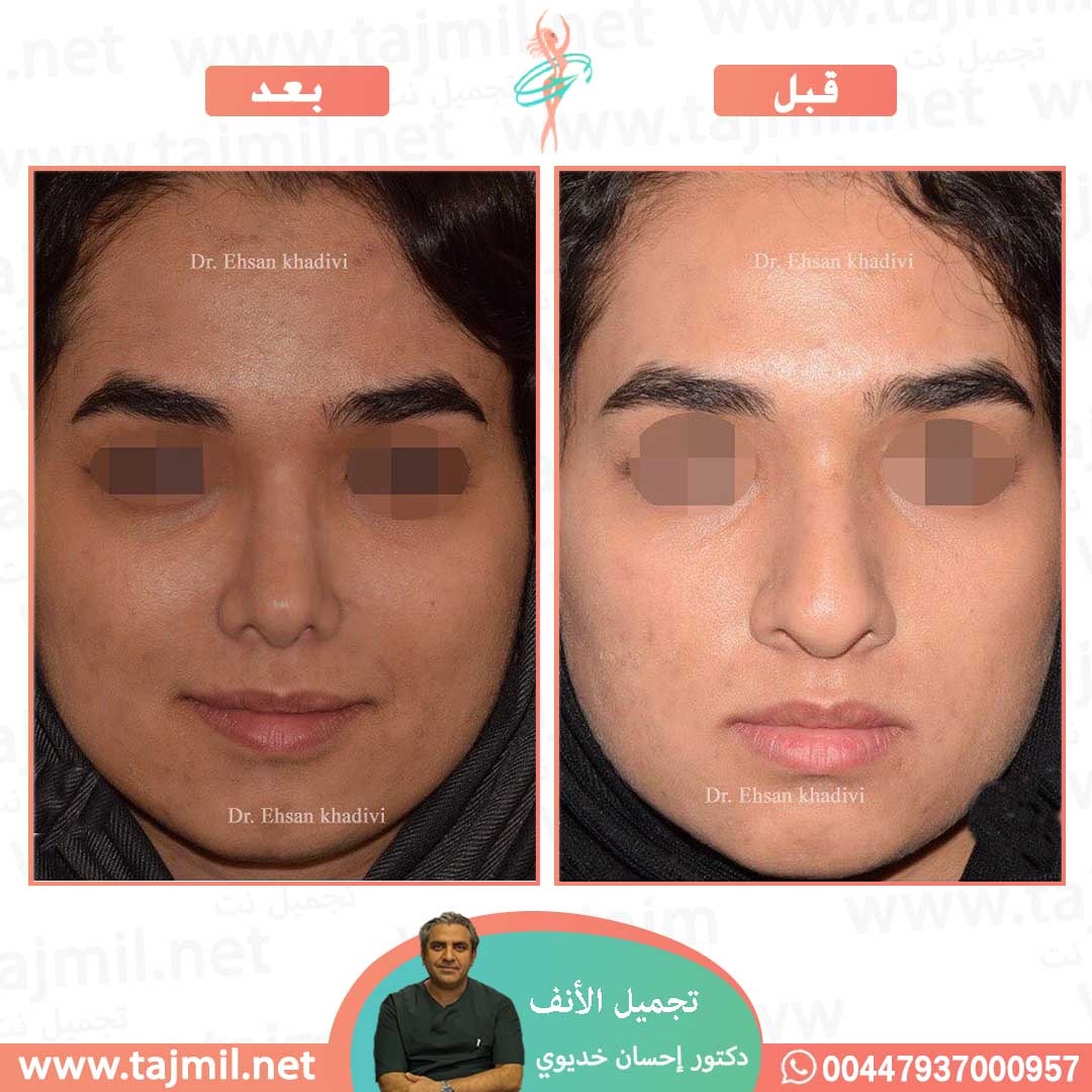  - دکتور إحسان خدیوي عملية تجميل الانف في ايران مع تجميل نت